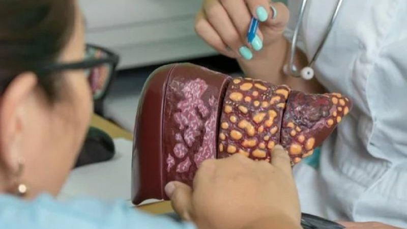 Gan nhiễm mỡ là tình trạng tích tụ chất béo tại gan
