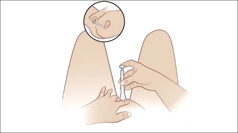 Đưa dụng cụ đặt thuốc v&agrave;o &acirc;m đạo theo c&aacute;ch nhẹ nh&agrave;ng v&agrave; nhấn p&iacute;t t&ocirc;ng của dụng cụ