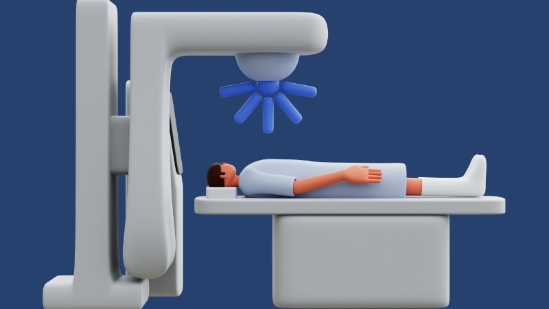 Người từng xạ trị phần ngực nên tầm soát ung thư vú định kỳ 