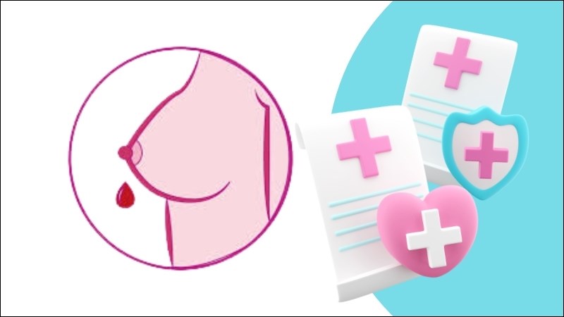 Núm vú tiết dịch lạ như máu là dấu hiệu của ung thư vú 