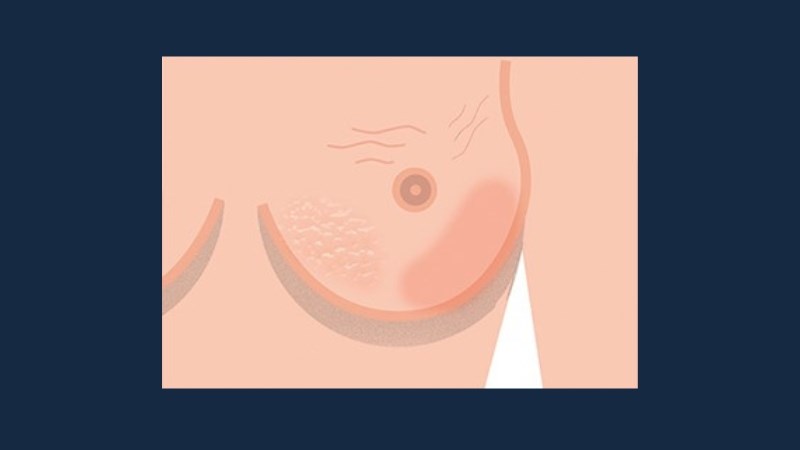 Vùng da quanh vú có thể có vảy hoặc lõm vào trong giống quả cam