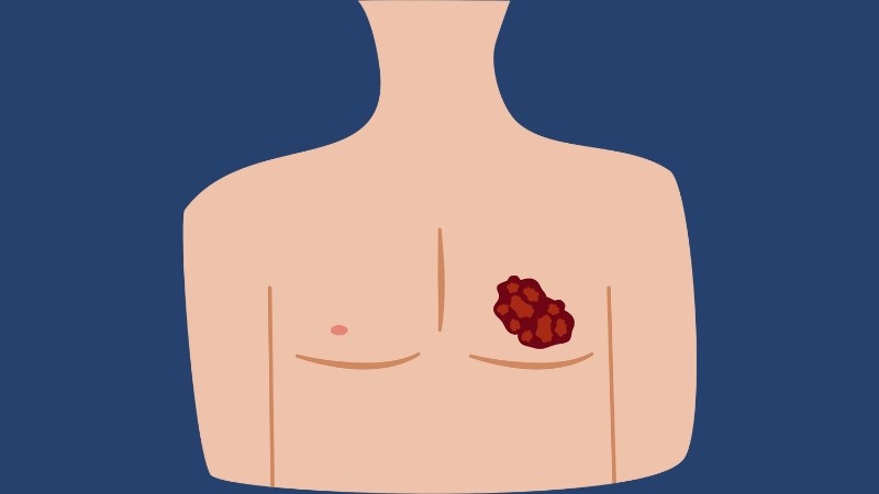 Xuất hiện các khối u ở vú 