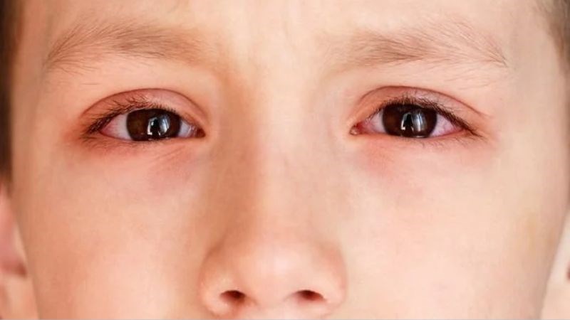 Dầu thầu dầu có khả năng kháng khuẩn, ngăn nhiễm trùng mắt