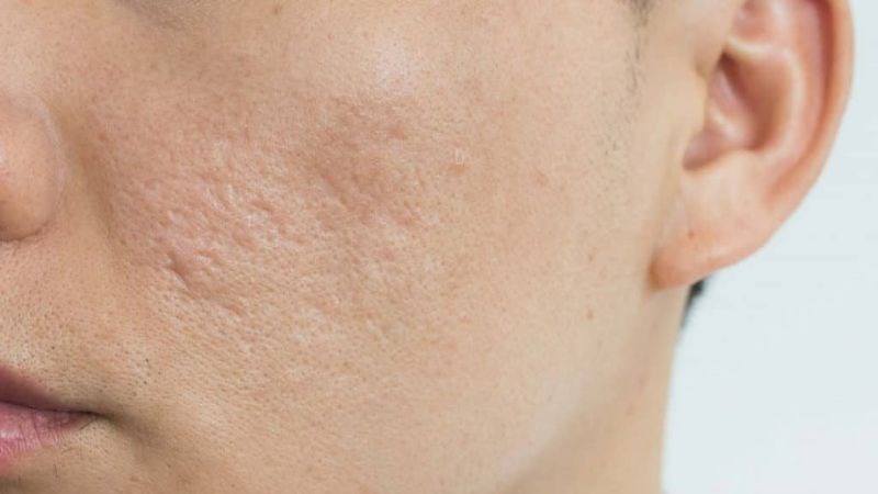 Dầu thầu dầu có tác dụng trị mụn và làm mờ sẹo trên da
