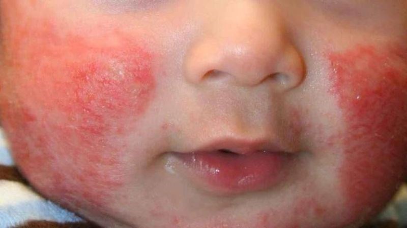 Hắc lào, chàm, nấm ở trẻ nhỏ có thể chữa trị bằng các bài thuốc từ thảo quyết minh