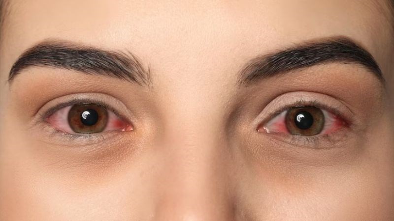 Bài thuốc thảo quyết minh giúp hỗ trợ điều trị chứng đau mắt đỏ hiệu quả