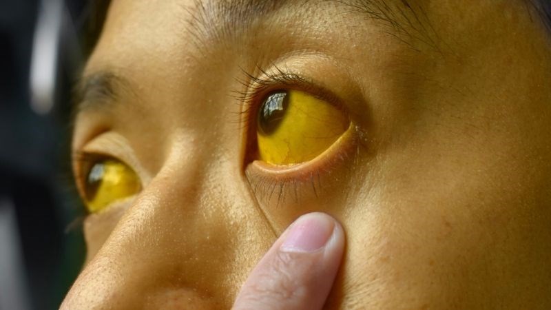 Bài thuốc từ hoàng đằng và cây xạ vàng giúp trị vàng da do bệnh gan