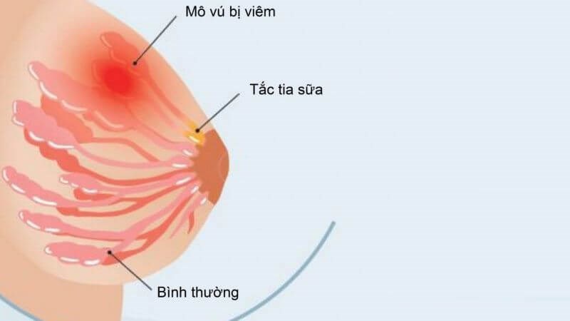 Chè vằng có thể giúp làm giảm sưng đau, cải thiện tuần hoàn máu và giảm áp lực trên tuyến vú