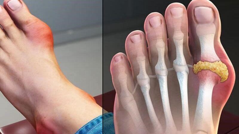 Chè vằng giúp ngăn ngừa và hỗ trợ điều trị bệnh gút
