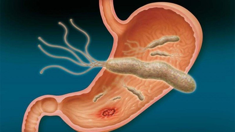 Một trong những nguyên nhân dẫn đến đau dạ dày do vi khuẩn Helicobacter Pylori (HP) gây ra
