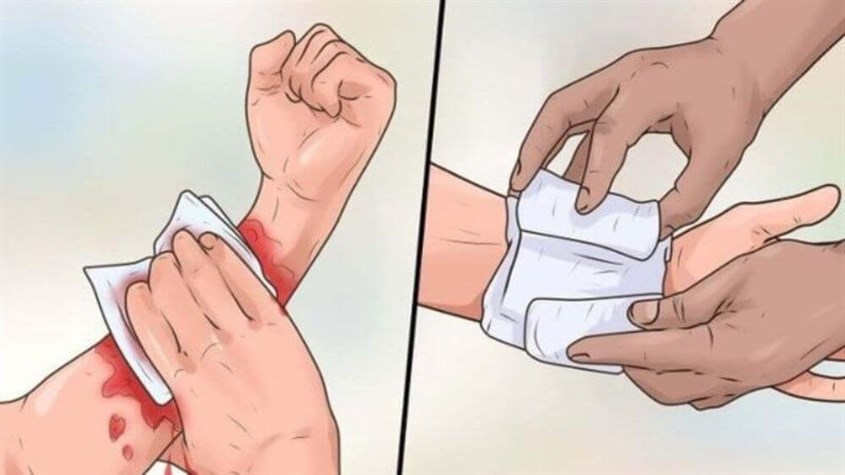 Nếu vết thương chảy nhiều máu, bạn cần dùng miếng băng gạc hoặc khăn sạch để ấn vài phút cho máu ngừng chảy