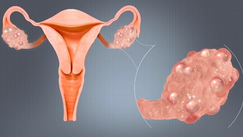 Hội chứng buồng trứng đa nang dẫn đến rối loạn kinh nguyệt
