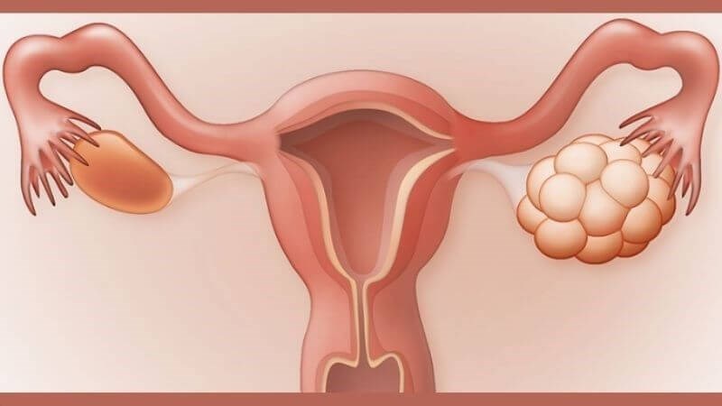 Vitamin E có thể giúp cân bằng hormone và cải thiện hội chứng buồng trứng đa nang