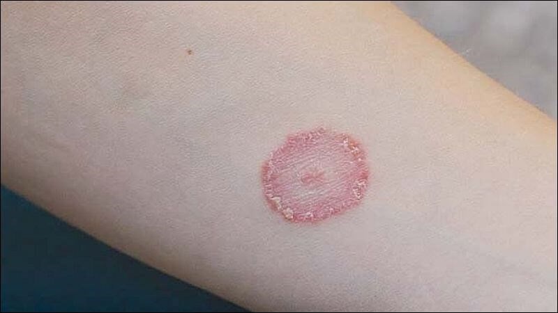 Nấm ngoài da đi kèm một số triệu chứng như vết ban đỏ hình tròn, sưng và ngứa
