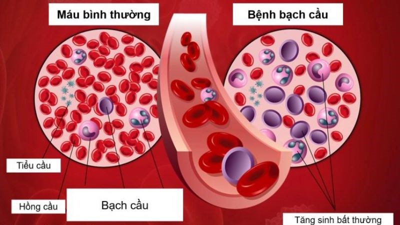 Bệnh bạch cầu là loại ung thư phổ biến nhất ở trẻ em và thanh thiếu niên
