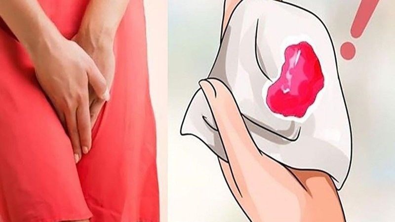 Tình trạng viêm phụ khoa nặng có thể làm chị em bị chảy máu âm đạo bất thường