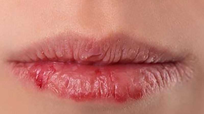 Môi nứt nẻ có lẽ là dấu hiệu cho biết cơ thể đang thiếu vitamin B6