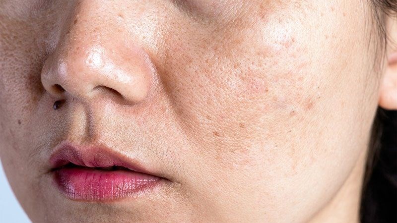 Vitamin B6 có khả năng ngăn chặn sự xuất hiện của các đốm sắc tố 