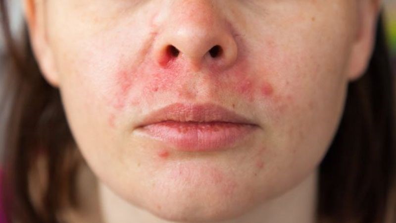 Thiếu vitamin B6 là một trong những nguyên nhân gây viêm da tiết bã