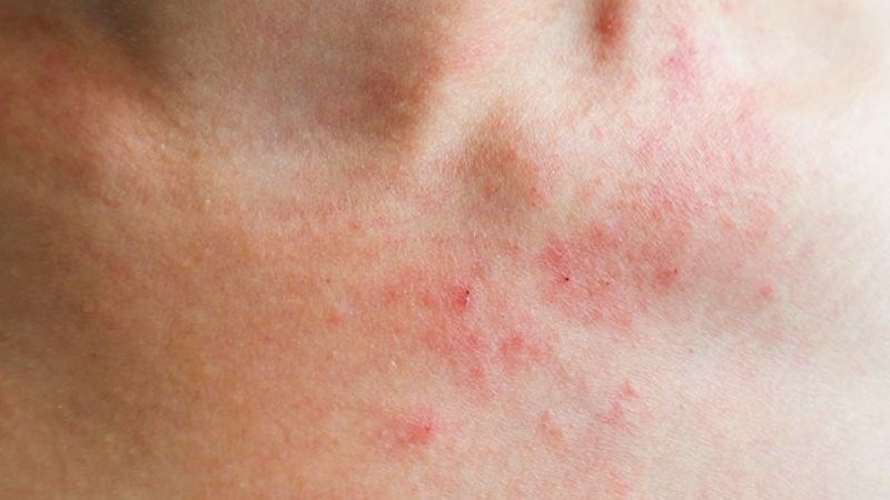 Vitamin B6 có thể giúp hạn chế tình trạng viêm trên da