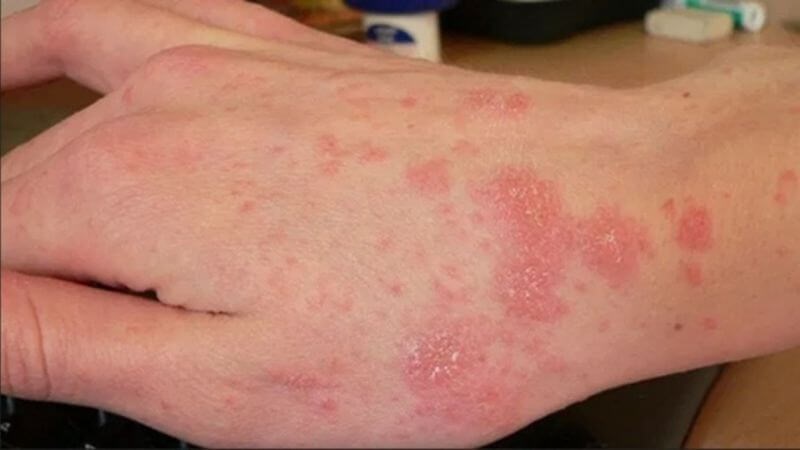 Vitamin B6 giúp kiểm soát các triệu chứng của bệnh chàm dị ứng
