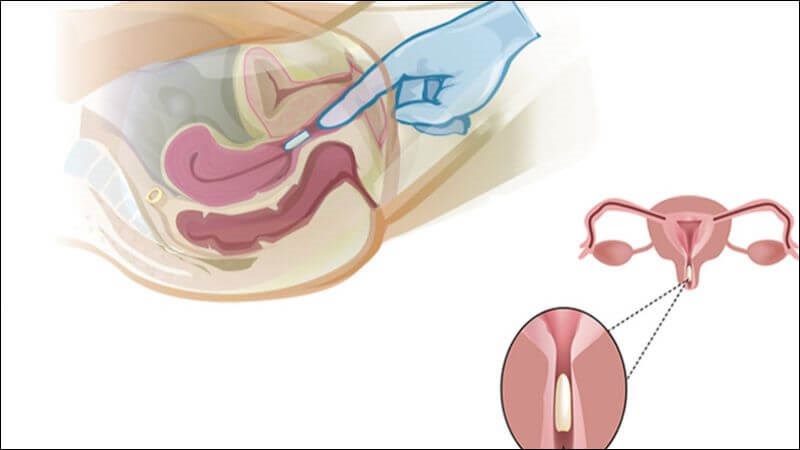 4. Cách đặt thuốc phụ khoa đúng cách