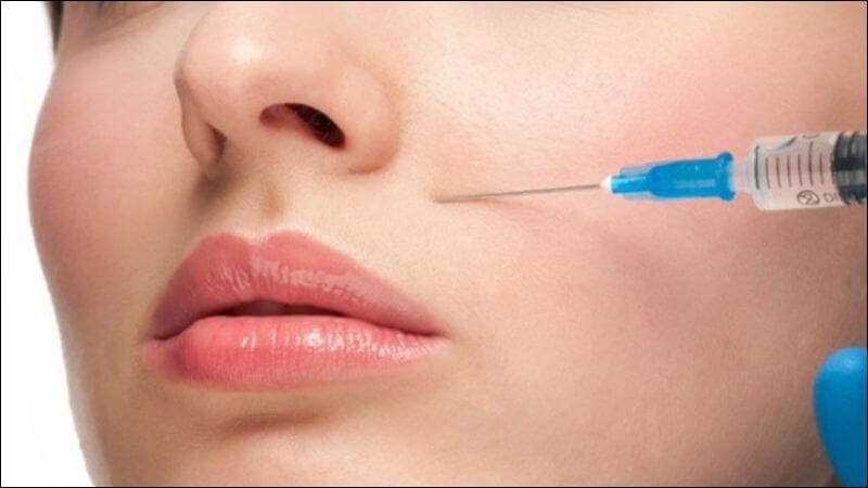 Lidocain thường được kết hợp với chất làm đầy HA để mang lại cảm giác thoải mái Lidocain thường được kết hợp với chất làm đầy HA để mang lại cảm giác thoải mái