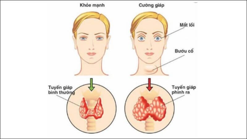 Bệnh Basedow là tình trạng tự miễn dịch gây ra tuyến giáp hoạt động quá mức (cường giáp), có thể dẫn đến lồi mắt gây mất cân đối