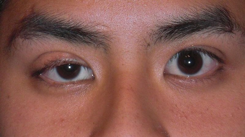 Sụp mí mắt (còn gọi là ptosis) có thể xuất hiện từ lúc sinh ra (bẩm sinh) hoặc phát triển sau này (mắc phải)