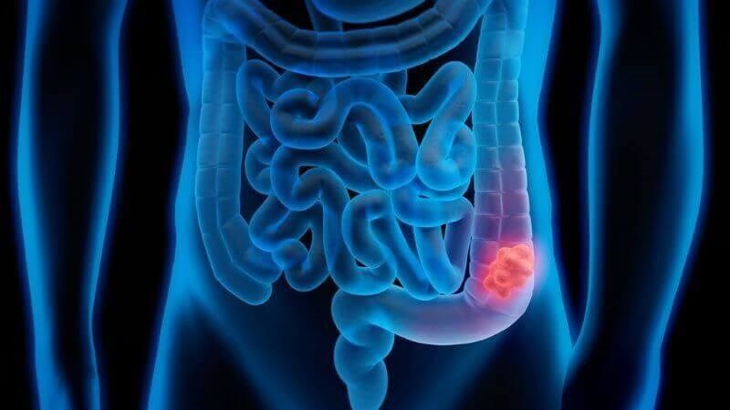 Đậu xanh có thể giảm nguy cơ phát triển polyp đại tràng - yếu tố nguy cơ cho ung thư đại tràng