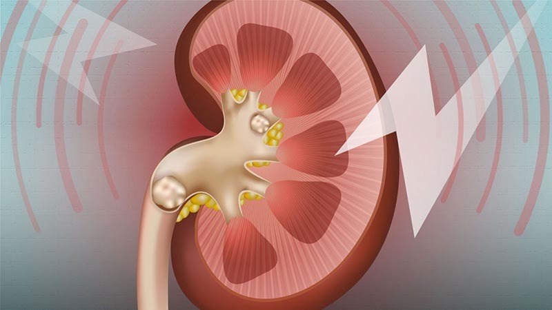Sỏi thận gây tắc nghẽn dòng nước tiểu dễ dẫn đến viêm tiết niệu