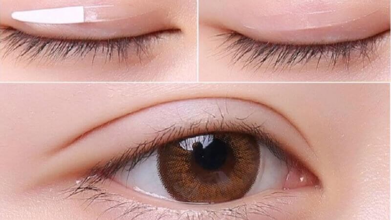 Cắt mí là thủ thuật được nhiều người thực hiện