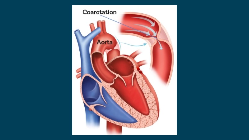 Hẹp eo động mạch chủ l&agrave; nguy&ecirc;n nh&acirc;n g&acirc;y tăng huyết &aacute;p thứ ph&aacute;t