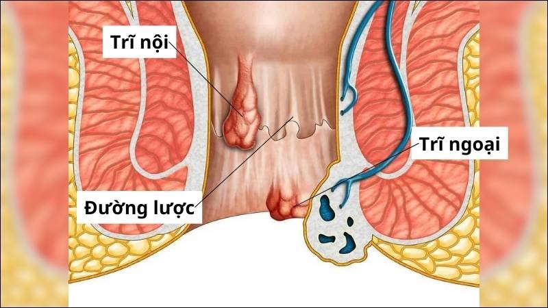 Phân loại bệnh trĩ phụ thuộc vào vị trí búi trĩ phát triển