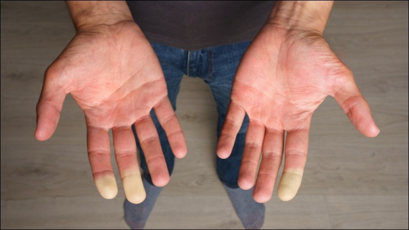 Hội chứng Raynaud làm cho các ngón tay đổi màu, cảm thấy lạnh tê
