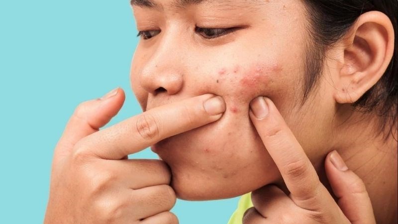 Tốt nhất là bạn không nên tự ý nặn mụn tại nhà