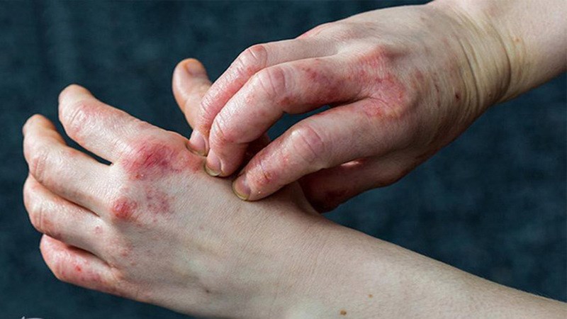 Chàm gây ra viêm, kích ứng dẫn đến ngứa, đỏ da