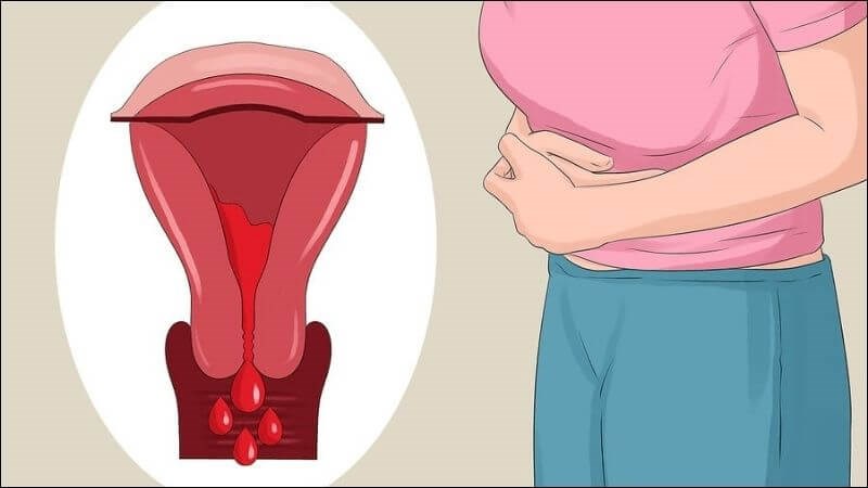 Đau bụng kinh xảy ra do tử cung co bóp nhằm giúp đẩy lớp niêm mạc ra ngoài âm đạo