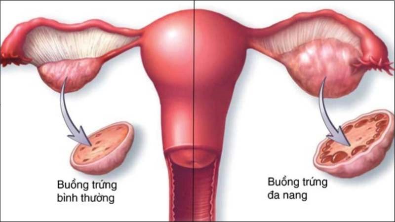 Hội chứng buồng trứng đa nang (PCOS) là vấn đề liên quan đến hormone ở phụ nữ 