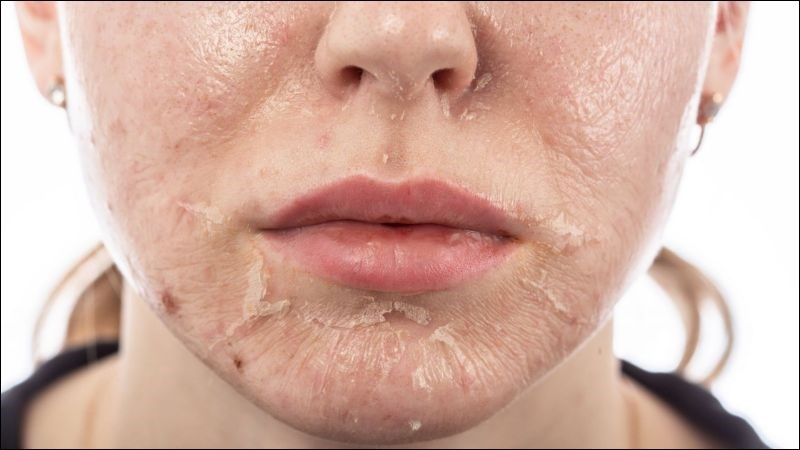Bạn có thể cần dùng băng gạc nếu có vết thương hở sau khi peel da sâu