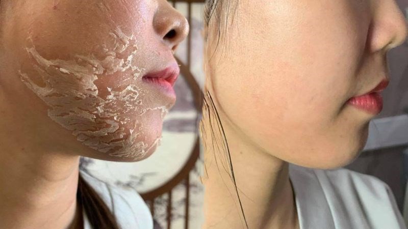 Peel da là phương pháp tẩy bào chết mạnh nên không cần dùng tẩy tế bào chết