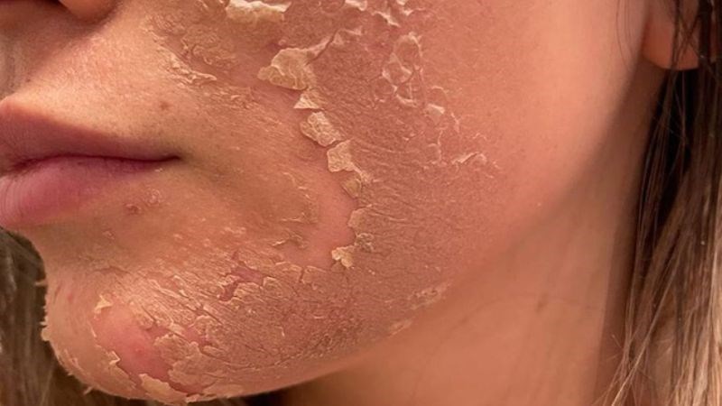 Da thường bị đóng vảy và sưng tấy đỏ nghiêm trọng sau khi peel da sâu