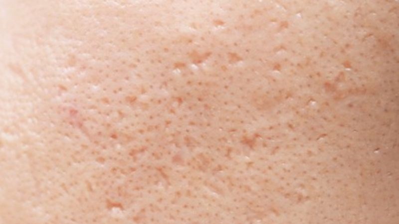 Peel da hiếm khi để lại sẹo