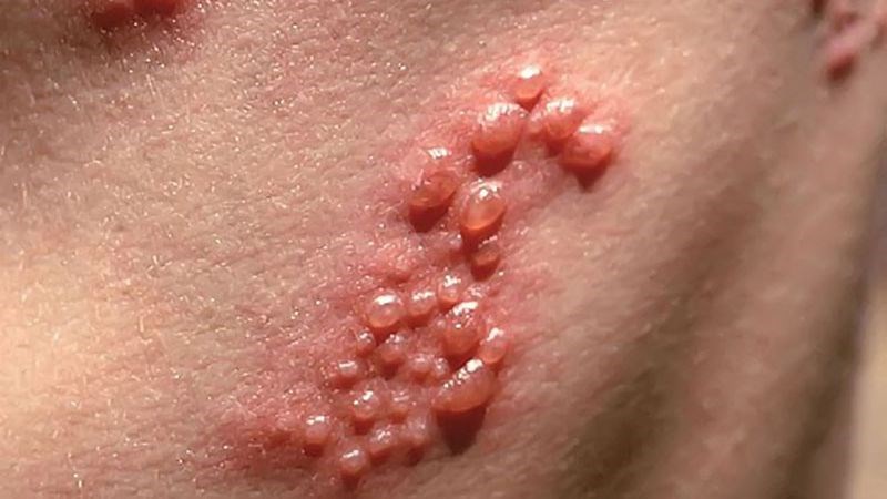 Chăm sóc da không đúng cách sau peel có thể dẫn đến nhiễm trùng