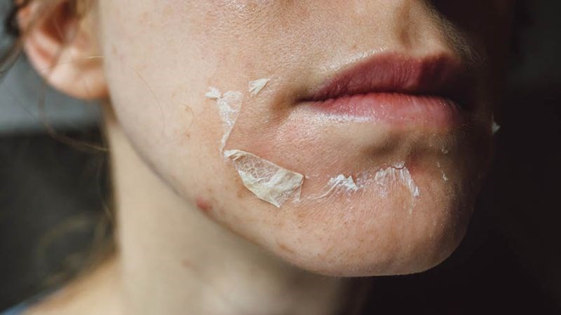 Tránh dùng tay chạm hay gãi trên da sau khi peel