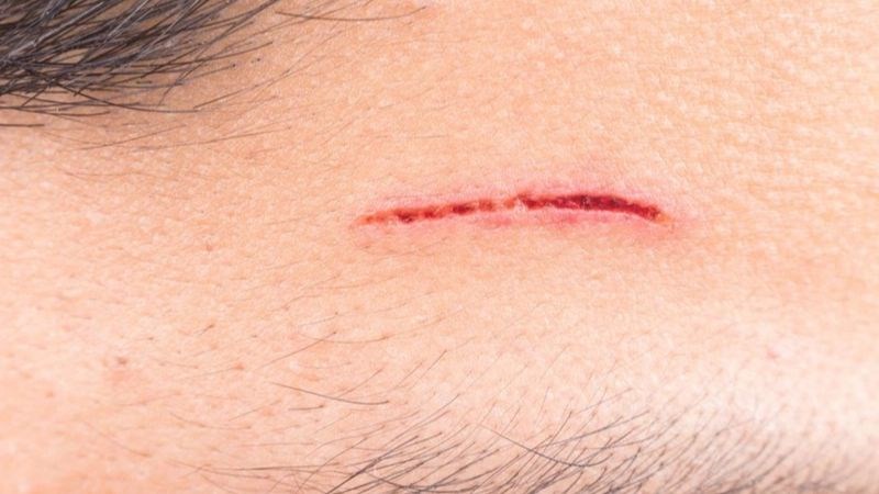 Lá chanh có khả năng tiêu diệt vi sinh vật gây nhiễm trùng vết thương