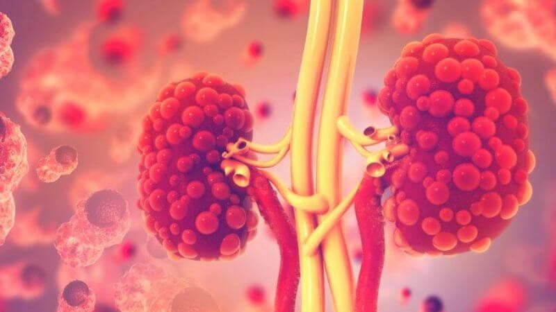 Bệnh nang thận là tình trạng nang thận xuất hiện bất thường trong nhu mô thận