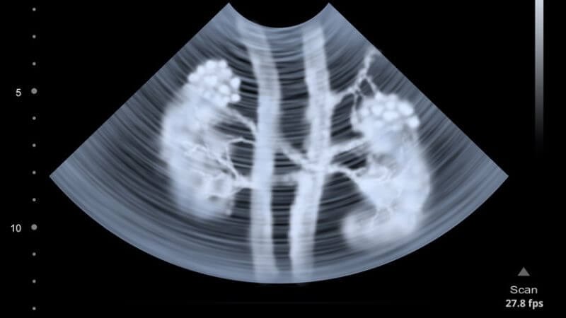 Siêu âm là phương pháp tiện lợi để chẩn đoán và theo dõi bệnh nang thận