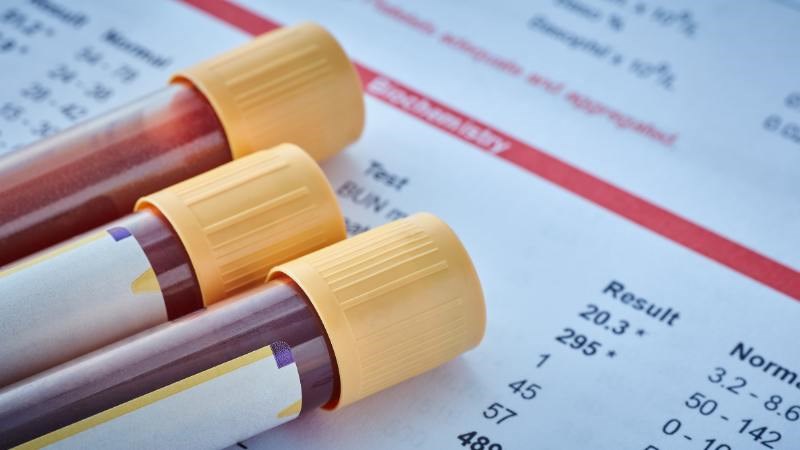 Công thức máu là xét nghiệm quan trọng nhất để chẩn đoán thiếu máu