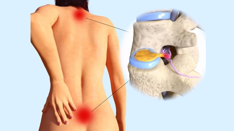 Phần đĩa đệm thoát vị có thể chèn ép lên tủy sống và rễ thần kinh